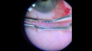 Meibomian Gland Expression (Upper and Lower Lid)