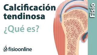 Calcificación tendinosa - Qué es, causas, síntomas y tratamiento