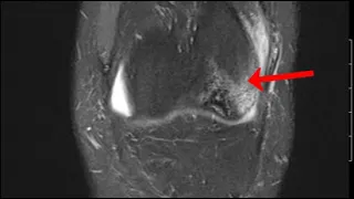 Medullary Infarcts | MRI of the Left Knee