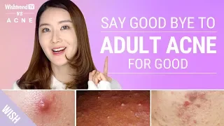 How To Completely Get Rid Of Adult Acne! | WishtrendTV vs ACNE
