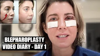 Blepharoplasty Video Diary - Day 1 After Surgery (1 of 15)