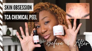 25% TCA CHEMICAL PEEL (Skin Obsession) | Step by step tutorial | before and after results