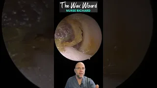 HUGE EAR WAX! #ear #earwax #earwaxremoval #fyp #foryourpage #viral #foryou #asmr #satisfying