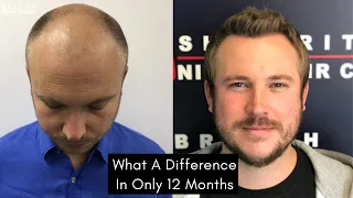 The British Hair Clinic - 'What A Difference In Only 12 Months'