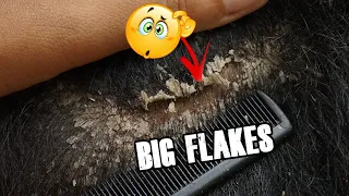 DRY FLAKY SCALP!! Satisfying Dandruff Removal - Scalp Scratching And Picking Psoriasis