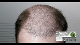 Μία εβδομάδα μετά τη μεταμόσχευση μαλλιών