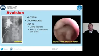 COMPLICATIONS OF RIRS BY DR.YILOREN TANIDIR