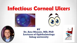 Infectious Corneal Ulcers