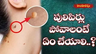 పులిపిర్లు పోవడానికి చిట్కాలు  | Removal And Prevention Of Warts | Veda vaidhyam | Hindu Dharmam