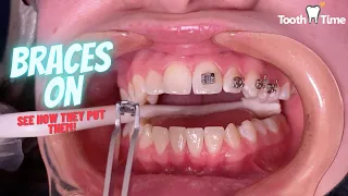 How do they put braces on - Tooth Time Family Dentistry New Braunfels