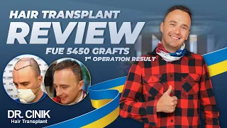 Dr.Cinik Hair Transplant | FUE | Before After 5450 Grafts | Hair Growth Results in 1 Year