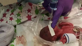 Hospital reveals world's tiniest surviving baby