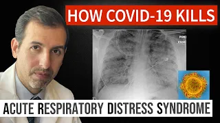 How Coronavirus Kills: Acute Respiratory Distress Syndrome (ARDS) & COVID 19 Treatment