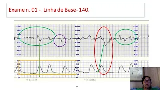 Avaliando um exame de Cardiotocografia fetal.