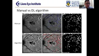 AI in Healthcare Series Workshop: 7 - Using deep learning to analyse stargardt disease progression