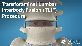 Transforaminal Lumbar Interbody Fusion(TLIF) Procedure