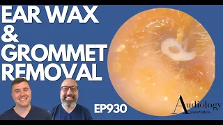 EAR WAX & GROMMET REMOVAL, MIDDLE EAR EFFUSION & TYMPANOSCLEROSIS - EP930