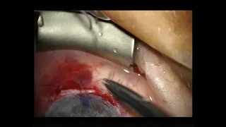 Corneal wedge excision for PMCD 25022019