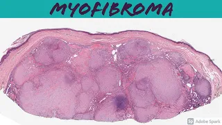Myofibroma & Myofibromatosis 101