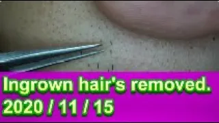 Extractions Ingrown Hair l Tweezers Beard l Full HD 2020/11/15