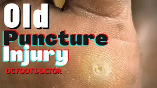 Old Puncture Injury : Removal of Porokeratosis 2 Years After Stepping On Glass