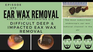 DIFFICULT DEEP & IMPACTED EAR WAX REMOVAL   EP 377