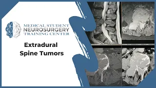 Extradural Spine Tumors