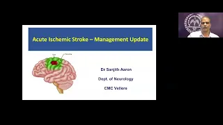 "Acute Ischemic Stroke-Management Update" -Lecture