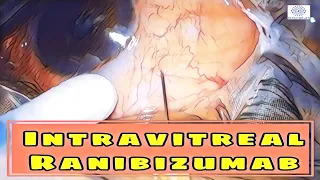 #153 How to inject Intravitreal Anti-VEGF (Ranibizumab) | Technique & tips @DrPrateekJain_eye