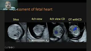 GE Webinar : Color Doppler Workshop by Dr Kamal Oswal