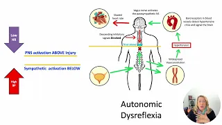 Understanding Autonomic Dysreflexia: A Critical Medical Emergency