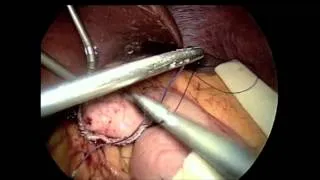 SAGES Top 21 Videos: Laparoscopic Roux-en-Y gastric bypass