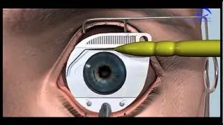 Лазерная коррекция зрения SUPER LASIK