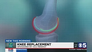 New technology makes it easier for knee replacement surgery