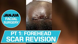 PART 1 - FOREHEAD SCAR REVISION - DR. TANVEER JANJUA - NEW JERSEY