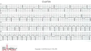 Premature Beats -- Atrial with Aberrancy or Ventricular... How to Tell FOR SURE!