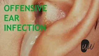 Smelly Ear Infection - Removal of Dead Skin & Debris by Endoscopic Suction - #382