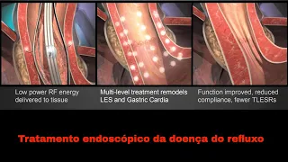 Tratamento endoscópico da doença do refluxo