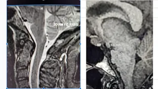 Don't mistake this for a Chiari malformation