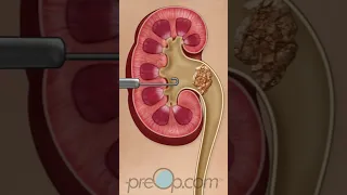 PreOp® 🏥 Kidney Stone Procedures: What to Expect #preop #shorts #health 📅