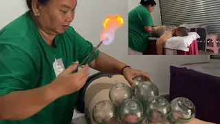 Taking my husband for Chinese fire Cupping therapy he has been in pain