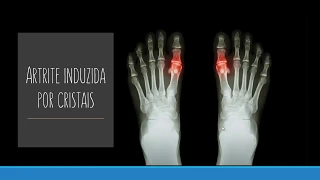 Doenças que atingem o sistema osteoarticular – artrite gotosa (gota)