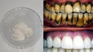 Wybielanie zębów w domu w 5 minuty || Jak naturalnie wybielić żółte zęby || Część 2