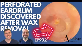 PERFORATED EARDRUM DISCOVERED AFTER EAR WAX REMOVAL - EP932