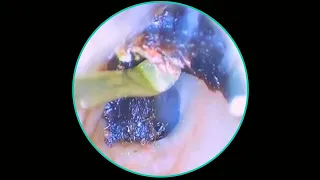 Relaxing Ear Wax Removal Very SATISFYING #113