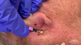 Blackhead Comedones Extraction Party Behind the Ear