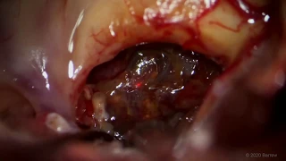 Contralateral Transcallosal-Subchoroidal Approach for Thalamic Cavernous Malformation Resection