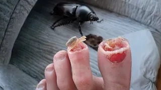 these bugs can eat toes..