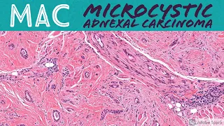 Microcystic adnexal carcinoma (MAC) (AIP France 2021 - Case 3)