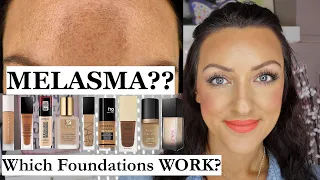 MELASMA?? Which Foundations Cover It?